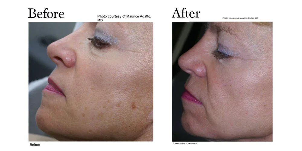 Mariposa Aesthetics & Laser Center LimeLight IPL Photofacial by Cutera®