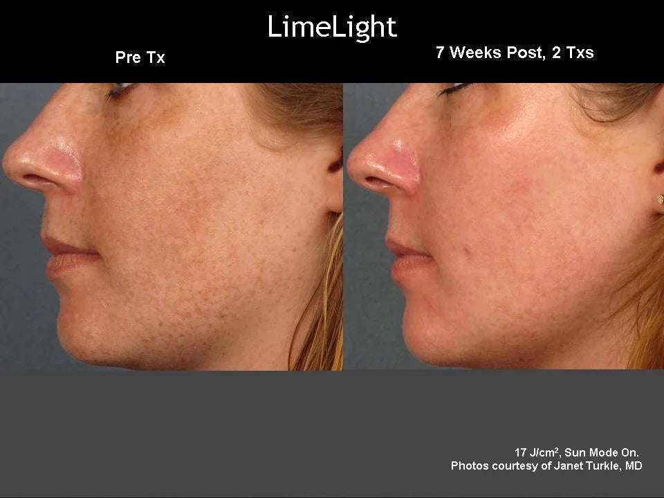 Mariposa Aesthetics & Laser Center LimeLight IPL Photofacial by Cutera®