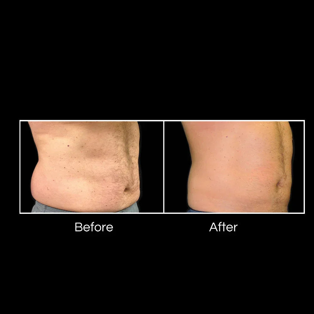 Mariposa Aesthetics & Laser Center Coolsculpting Elite Body Contouring Treatment