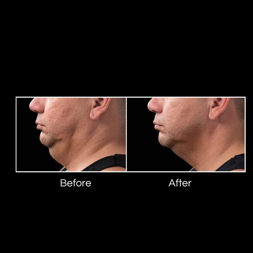 Mariposa Aesthetics & Laser Center Coolsculpting Elite Body Contouring Treatment