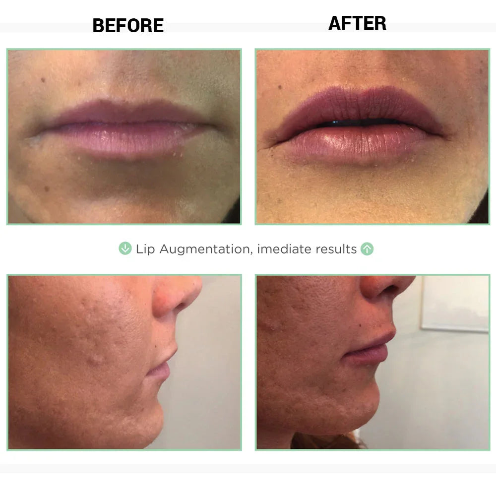 Mariposa Aesthetics & Laser Center NovaThreads PDO Suture Lift