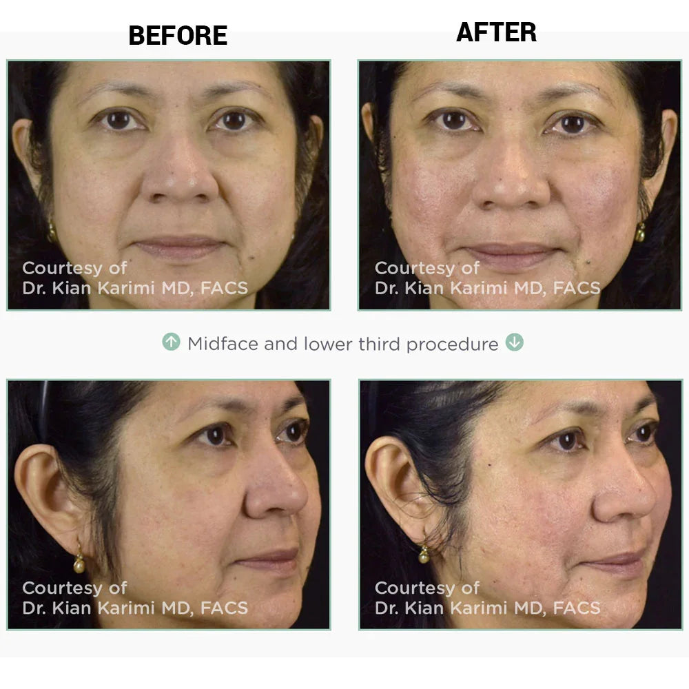 Mariposa Aesthetics & Laser Center NovaThreads PDO Suture Lift