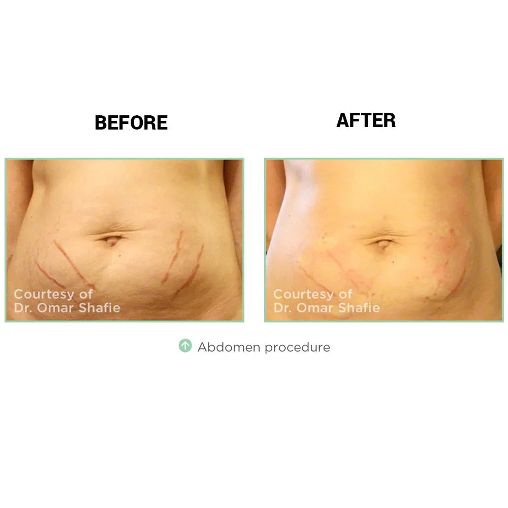 Mariposa Aesthetics & Laser Center NovaThreads PDO Suture Lift