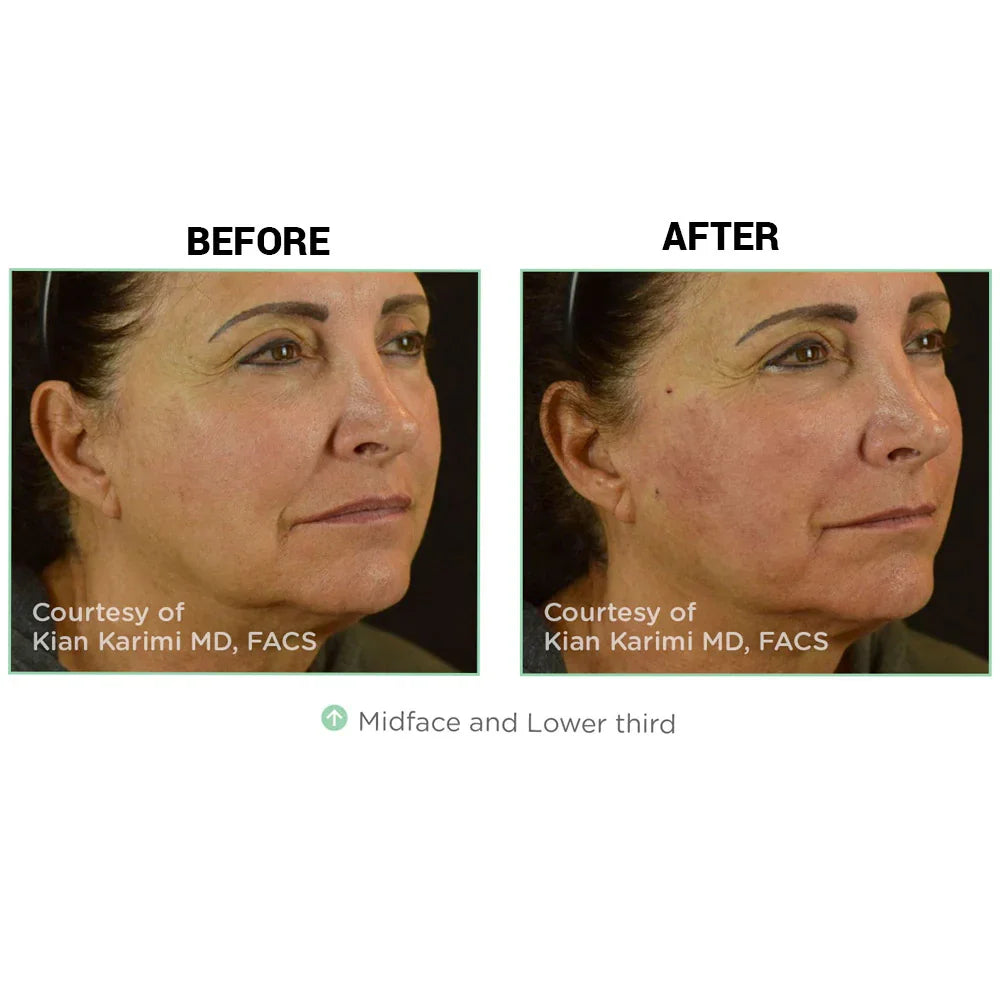 Mariposa Aesthetics & Laser Center NovaThreads PDO Suture Lift