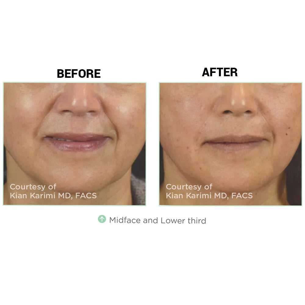 Mariposa Aesthetics & Laser Center NovaThreads PDO Suture Lift