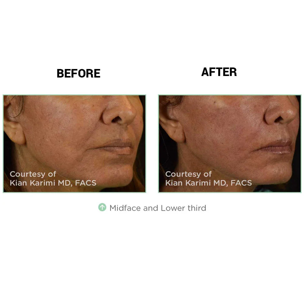 Mariposa Aesthetics & Laser Center NovaThreads PDO Suture Lift