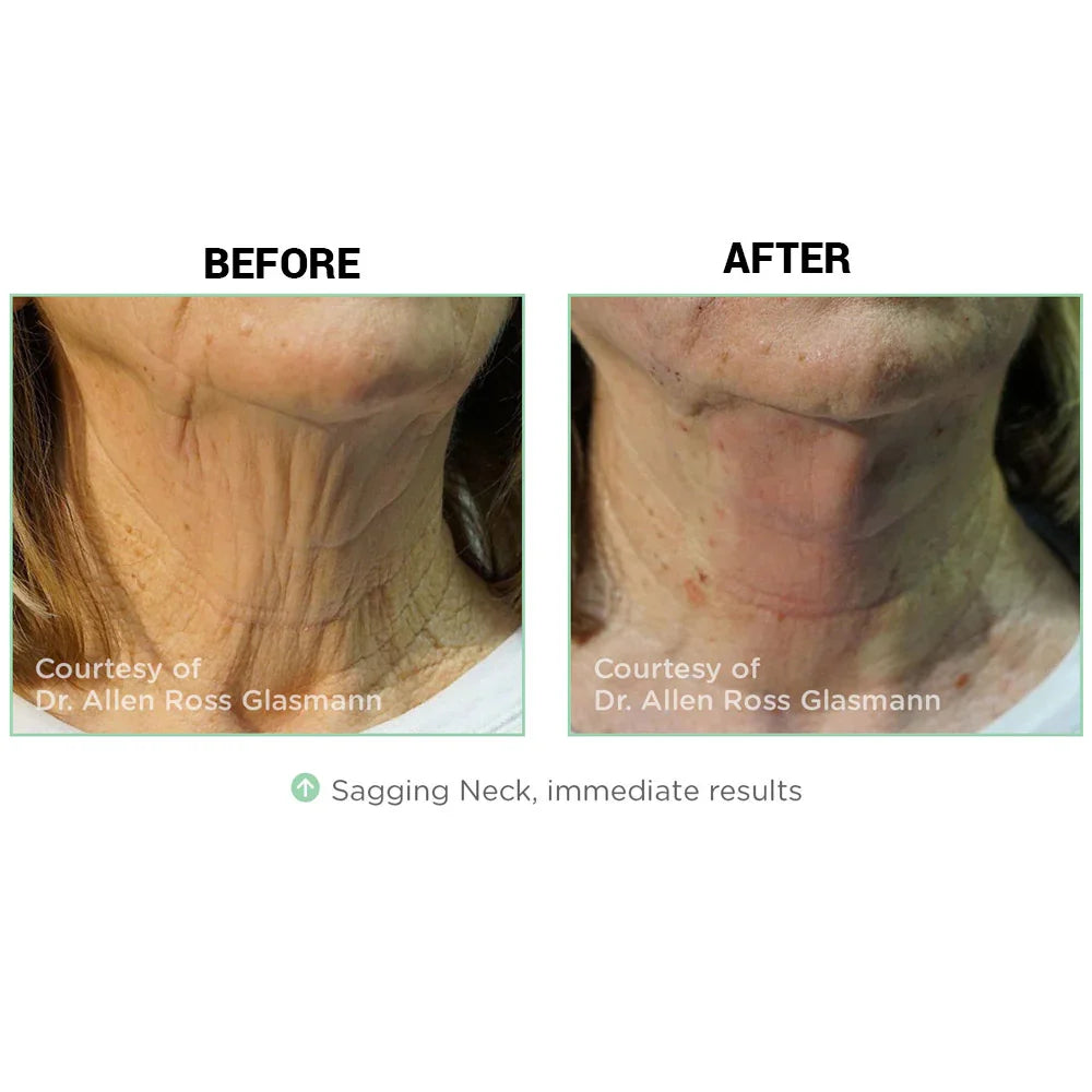 Mariposa Aesthetics & Laser Center NovaThreads PDO Suture Lift