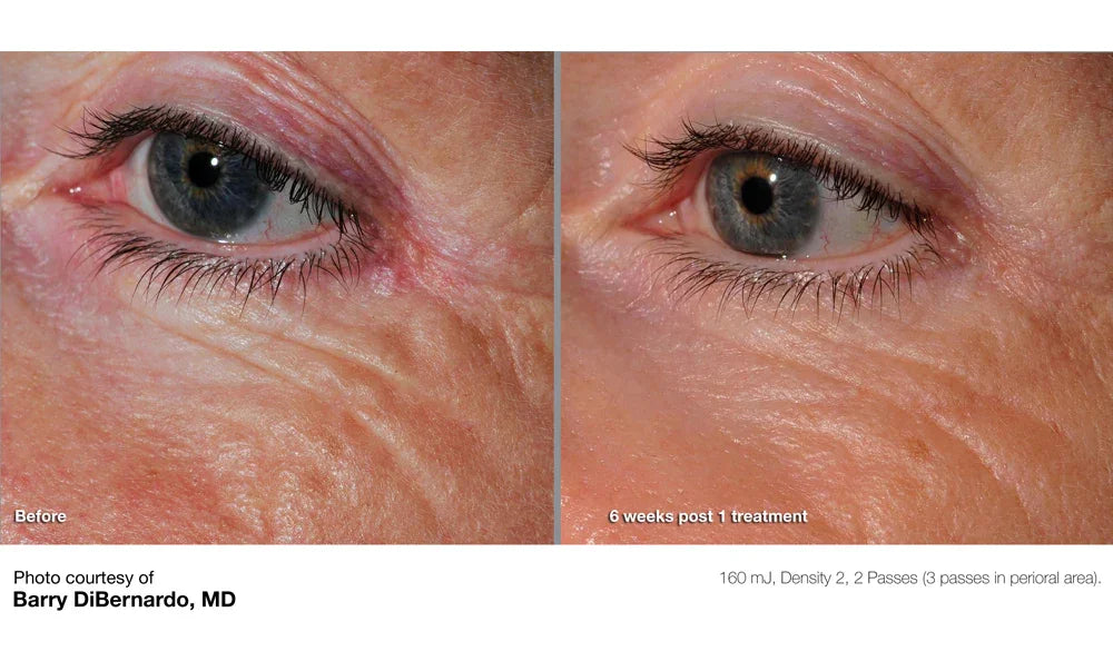 Mariposa Aesthetics & Laser Center Cutera Pearl Fractional Skin Resurfacing