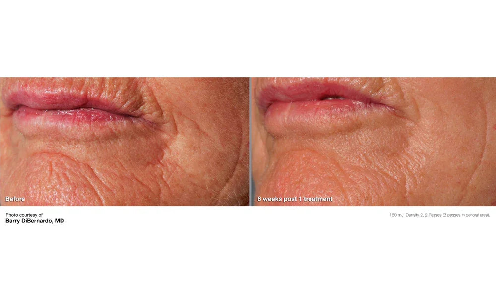 Mariposa Aesthetics & Laser Center Cutera Pearl Fractional Skin Resurfacing