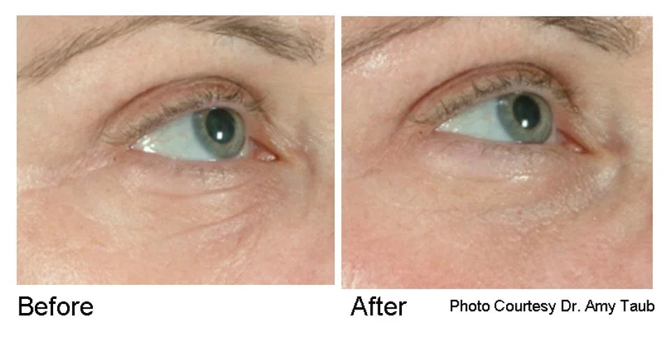 Mariposa Aesthetics & Laser Center Cutera Pearl Laser Skin Treatment