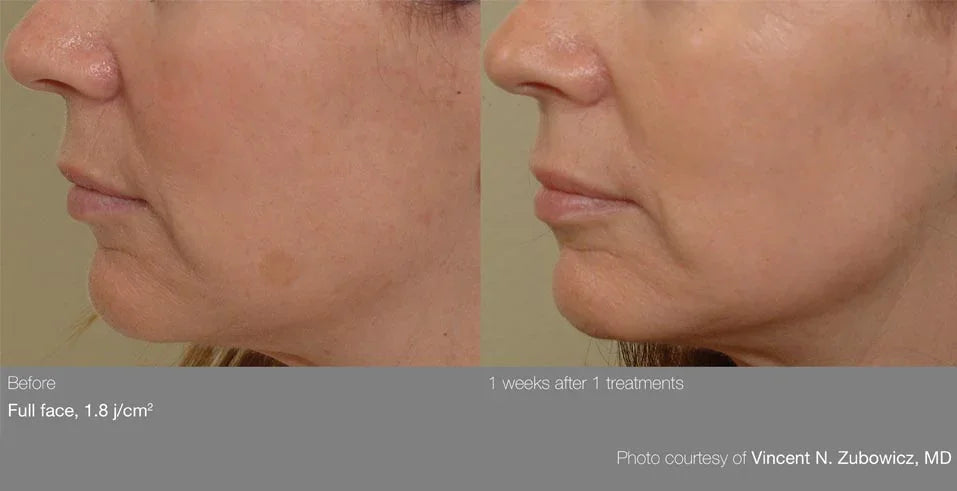 Mariposa Aesthetics & Laser Center Cutera Pearl Laser Skin Treatment