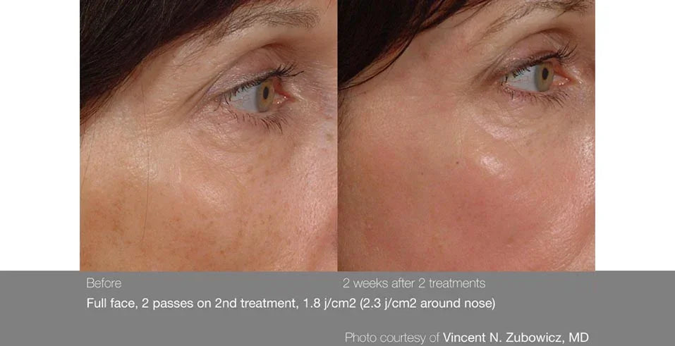 Mariposa Aesthetics & Laser Center Cutera Pearl Laser Skin Treatment