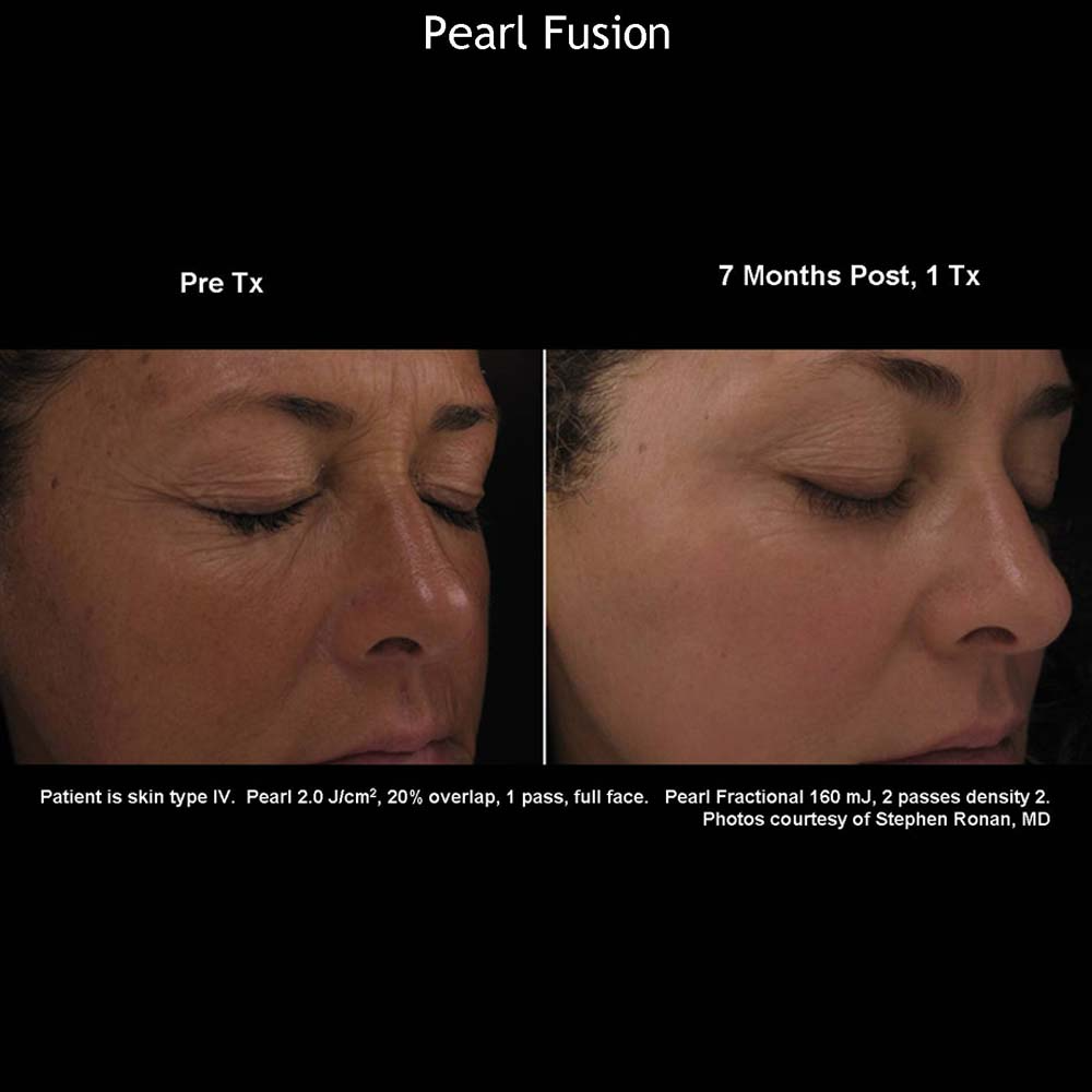 Mariposa Aesthetics & Laser Center Cutera Pearl Fusion Laser Treatment