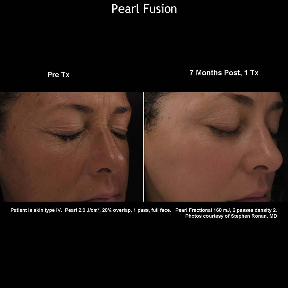 Mariposa Aesthetics & Laser Center Cutera Pearl Fusion Laser Treatment
