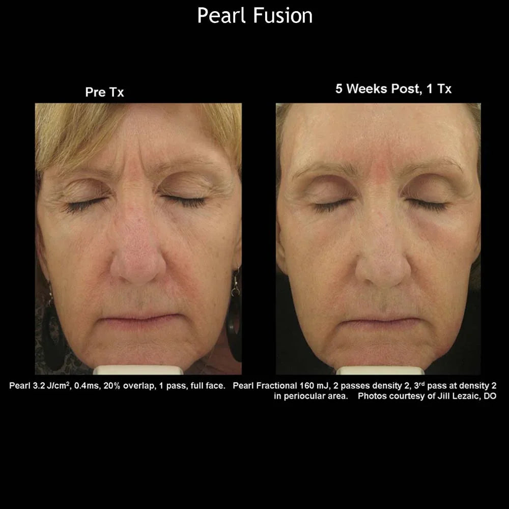 Mariposa Aesthetics & Laser Center Cutera Pearl Fusion Laser Treatment