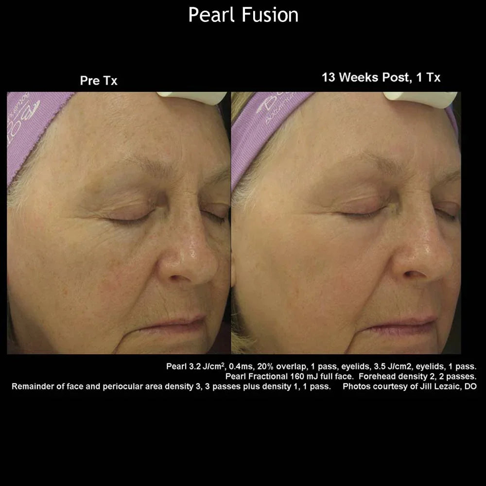 Mariposa Aesthetics & Laser Center Cutera Pearl Fusion Laser Treatment
