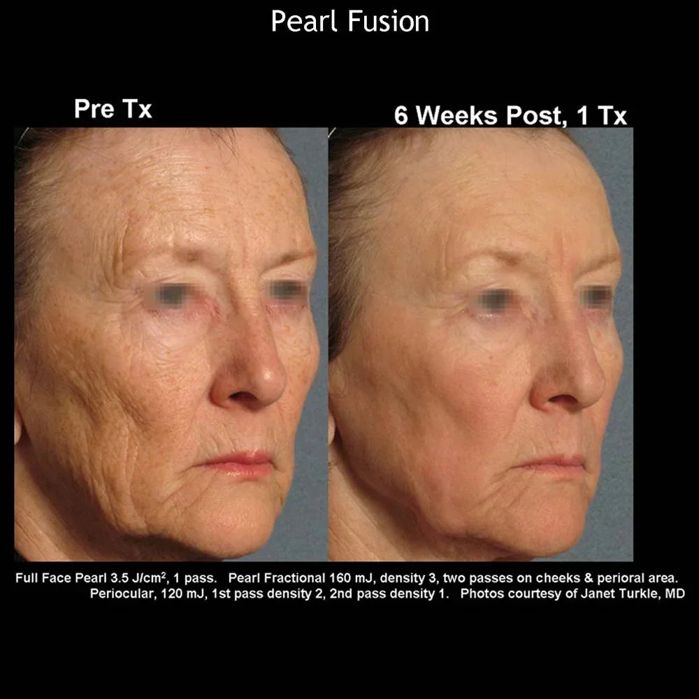 Mariposa Aesthetics & Laser Center Cutera Pearl Fusion Laser Treatment