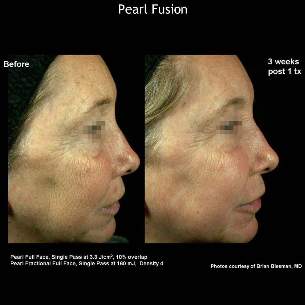 Mariposa Aesthetics & Laser Center Cutera Pearl Fusion Laser Treatment