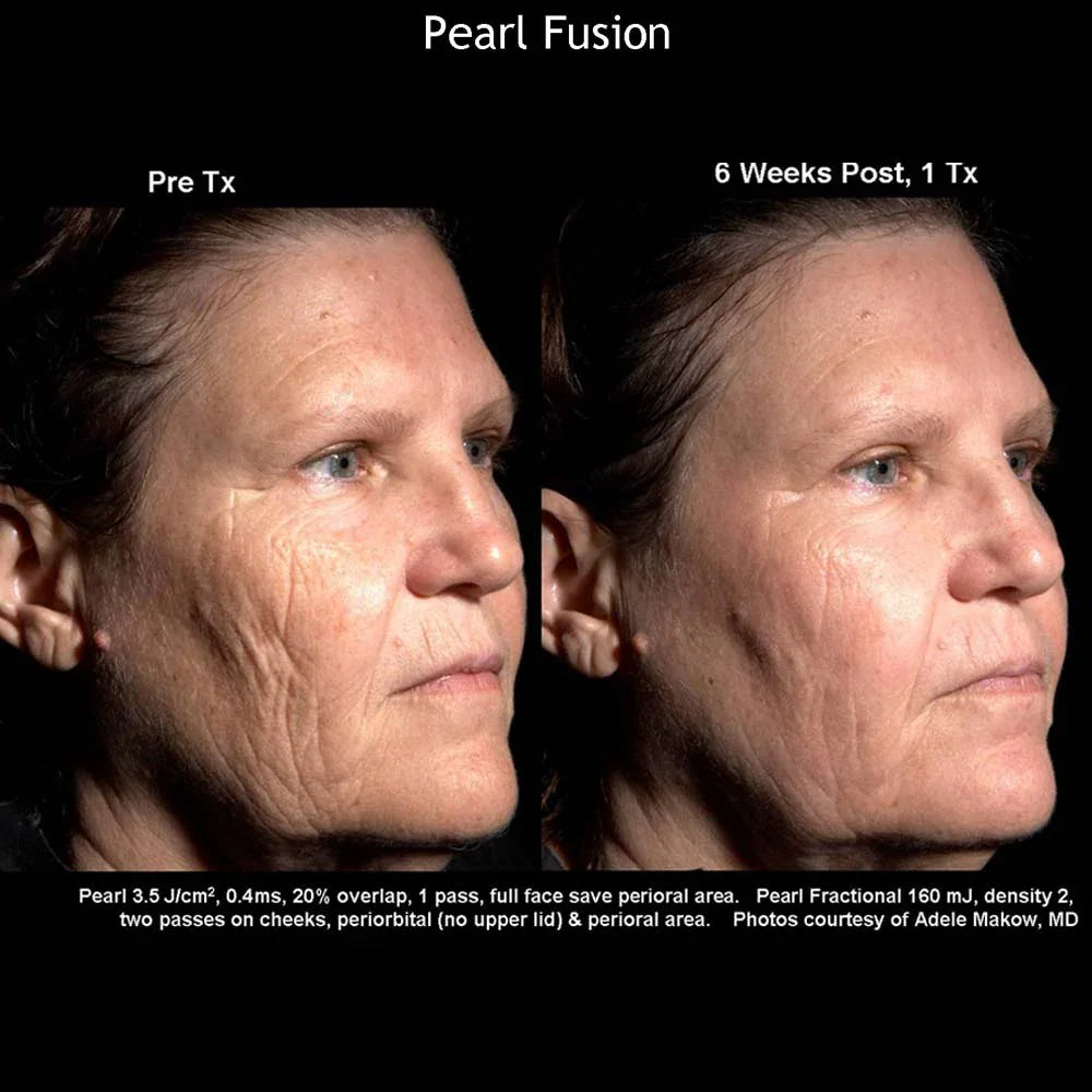 Mariposa Aesthetics & Laser Center Cutera Pearl Fusion Laser Treatment