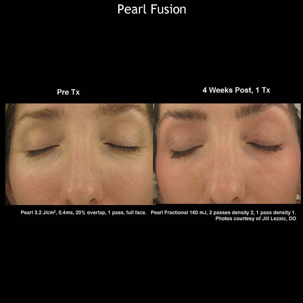 Mariposa Aesthetics & Laser Center Cutera Pearl Fusion Laser Treatment