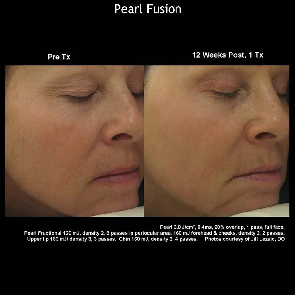Mariposa Aesthetics & Laser Center Cutera Pearl Fusion Laser Treatment
