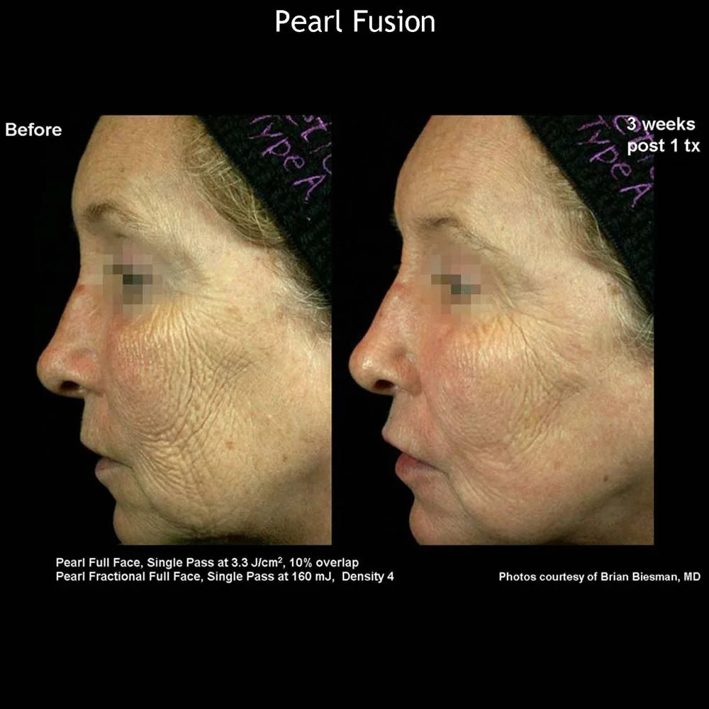 Mariposa Aesthetics & Laser Center Cutera Pearl Fusion Laser Treatment