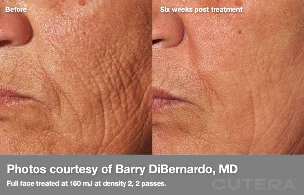 Mariposa Aesthetics & Laser Center Cutera Pearl Fractional Skin Resurfacing