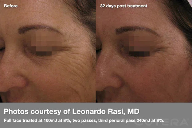 Mariposa Aesthetics & Laser Center Cutera Pearl Fractional Skin Resurfacing