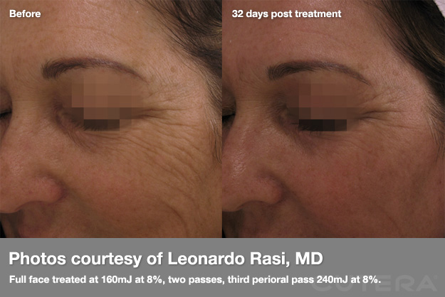 Mariposa Aesthetics & Laser Center Cutera Pearl Fractional Skin Resurfacing
