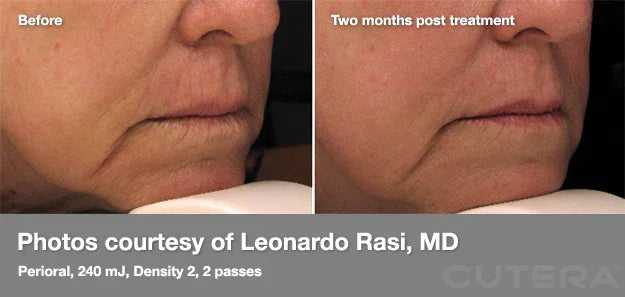 Mariposa Aesthetics & Laser Center Cutera Pearl Fractional Skin Resurfacing
