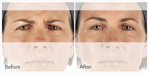 Mariposa Aesthetics & Laser Center Xeomin Neurotoxin Wrinkle Treatment