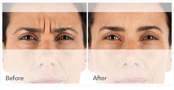 Mariposa Aesthetics & Laser Center Xeomin Neurotoxin Wrinkle Treatment