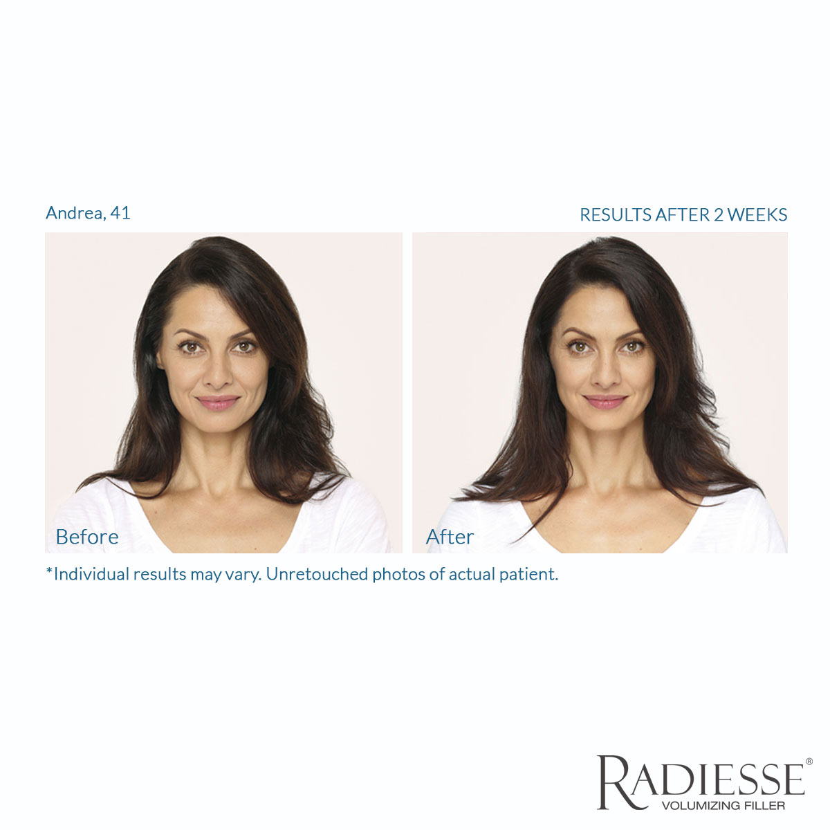 Mariposa Aesthetics & Laser Center RADIESSE® Dermal Filler & Collagen Booster