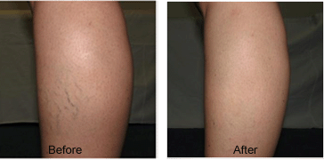 Mariposa Aesthetics & Laser Center Asclera® Sclerotherapy for Spider Veins