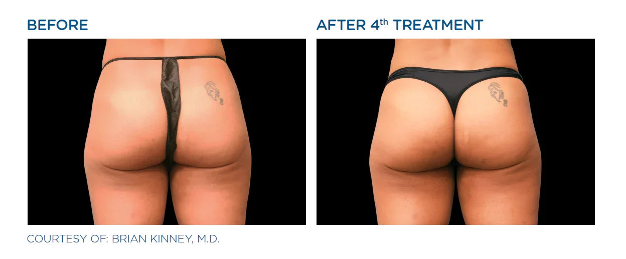 Mariposa Aesthetics & Laser Center EMSCULPT Body Contouring