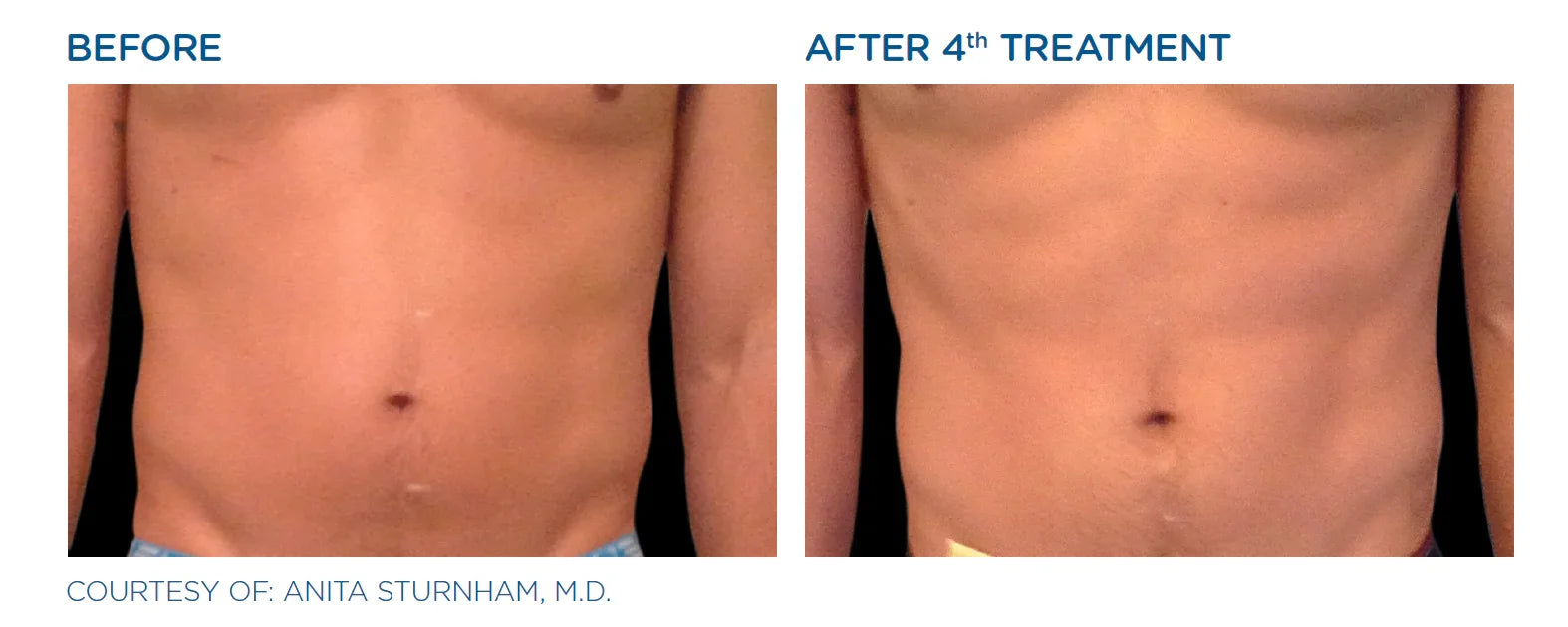 Mariposa Aesthetics & Laser Center EMSCULPT Body Contouring