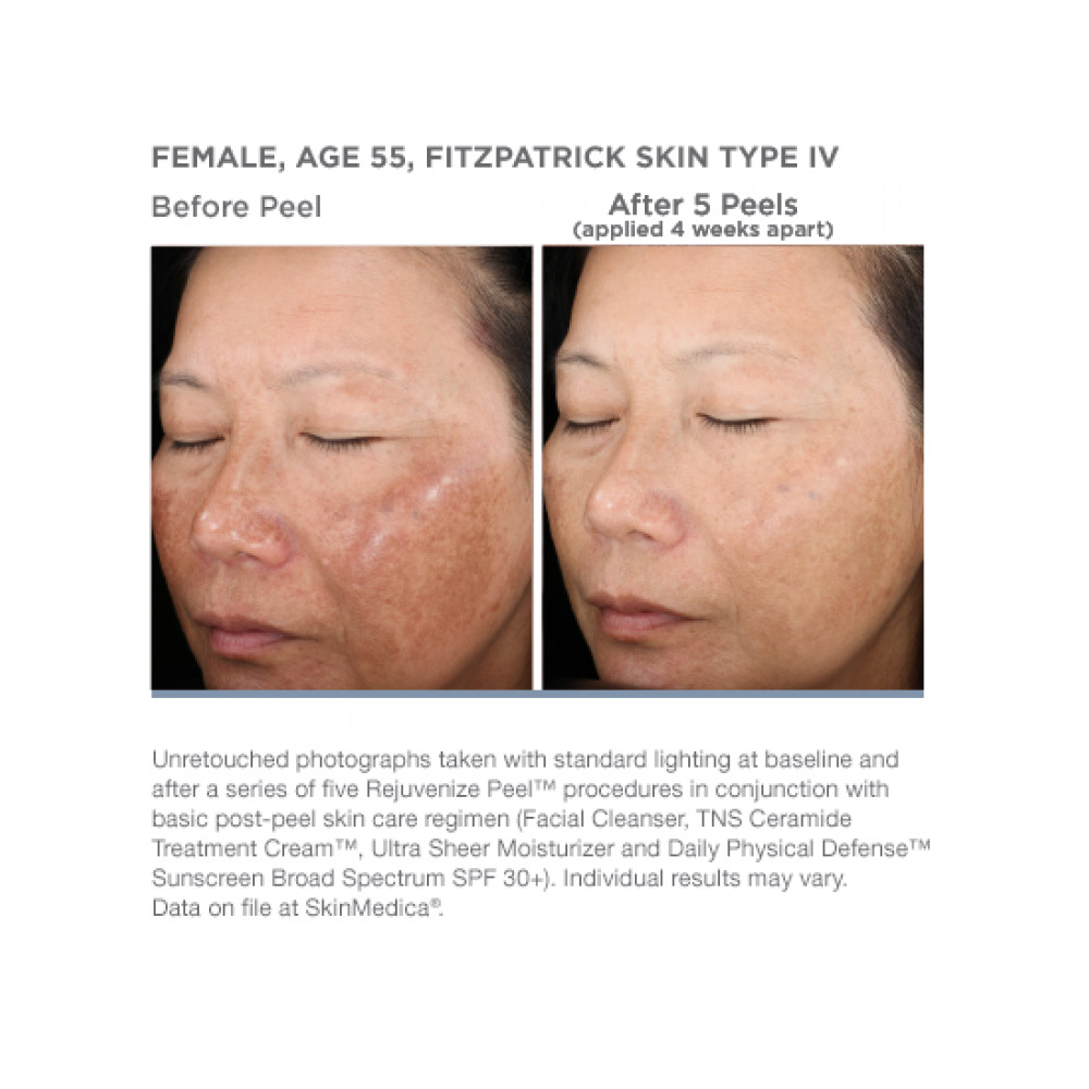 Mariposa Aesthetics & Laser Center SkinMedica Rejuvenize Peel for Radiant Skin