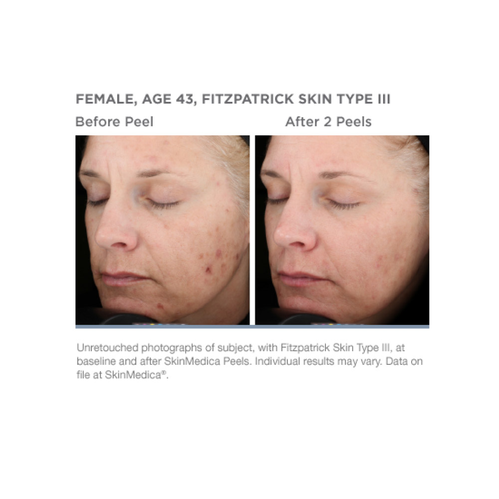 Mariposa Aesthetics & Laser Center SkinMedica Vitalize Peel - Experience Rejuvenation