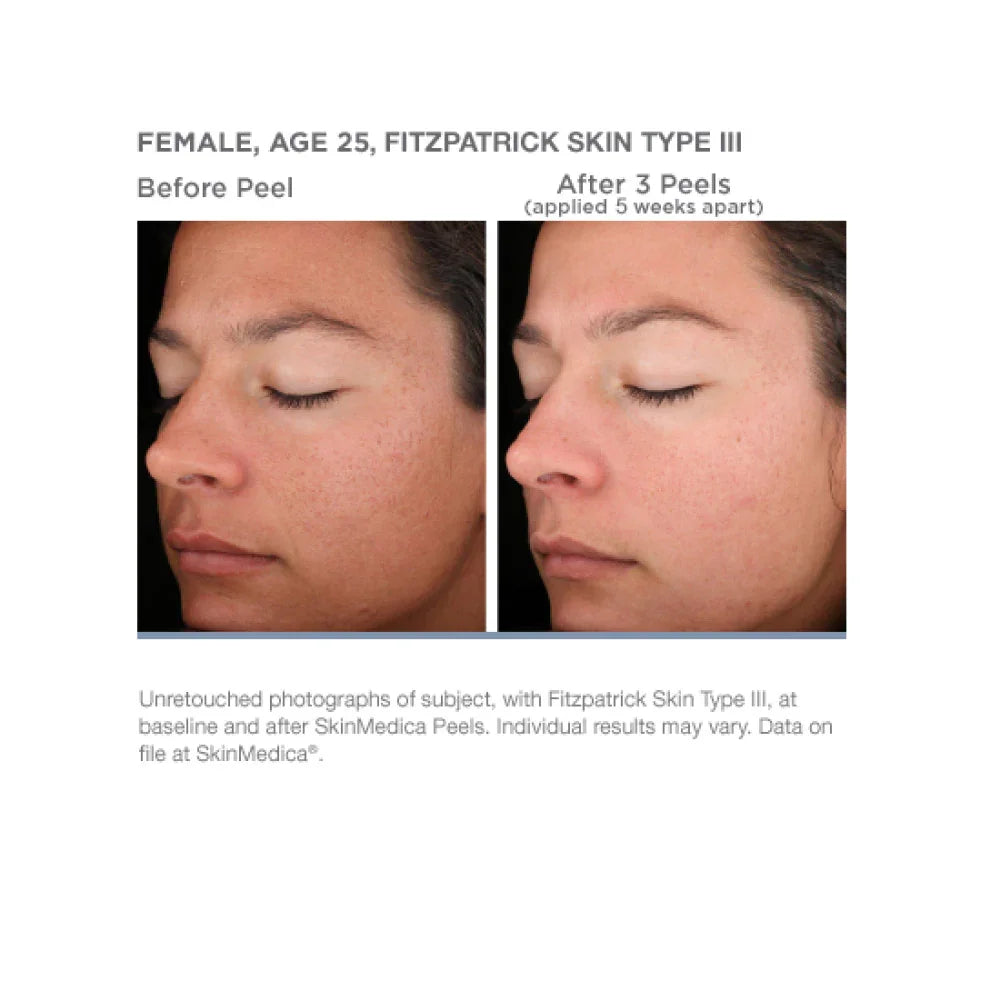 Mariposa Aesthetics & Laser Center SkinMedica Rejuvenize Peel for Radiant Skin