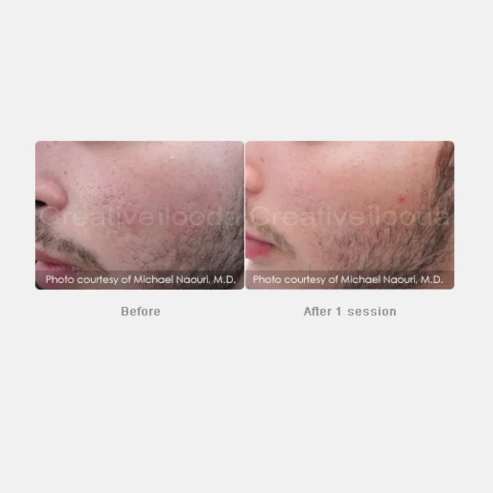 Mariposa Aesthetics & Laser Center Secret RF Microneedling Device