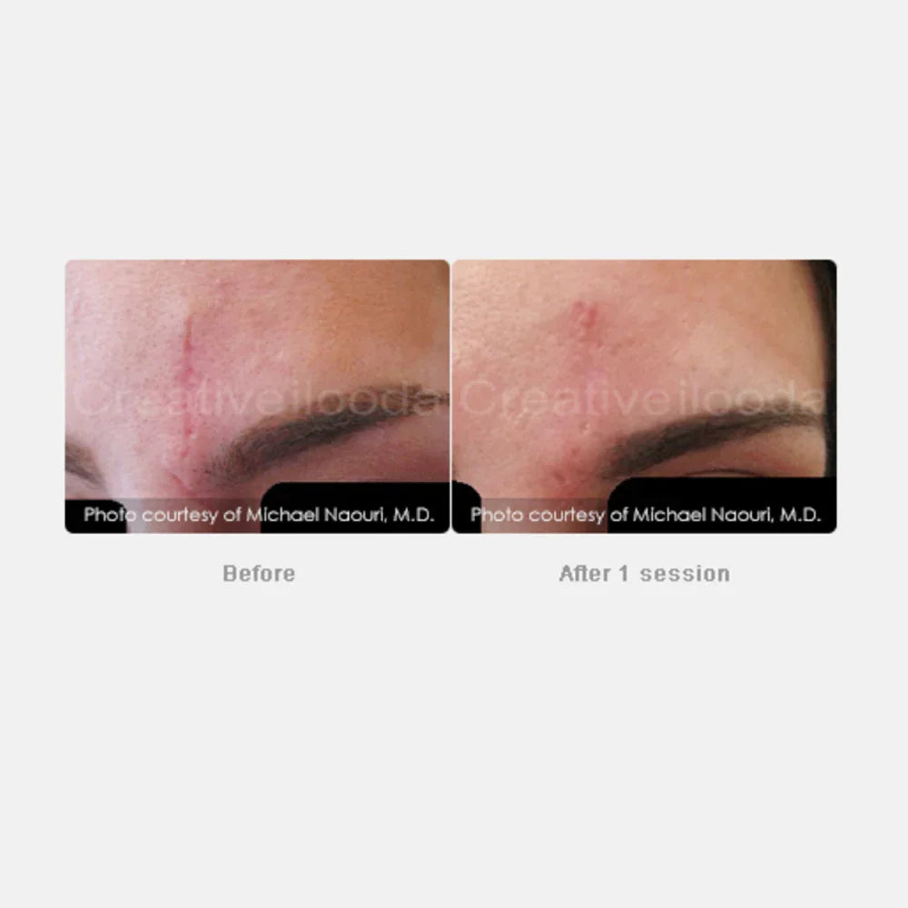 Mariposa Aesthetics & Laser Center Secret RF Microneedling Device