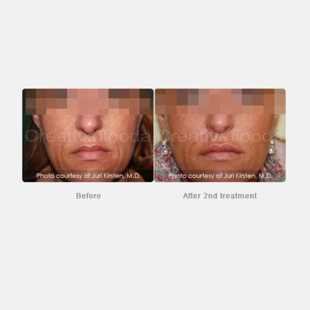 Mariposa Aesthetics & Laser Center Secret RF Microneedling Device