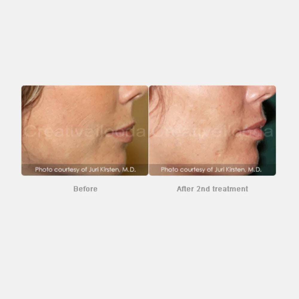 Mariposa Aesthetics & Laser Center Secret RF Microneedling Device
