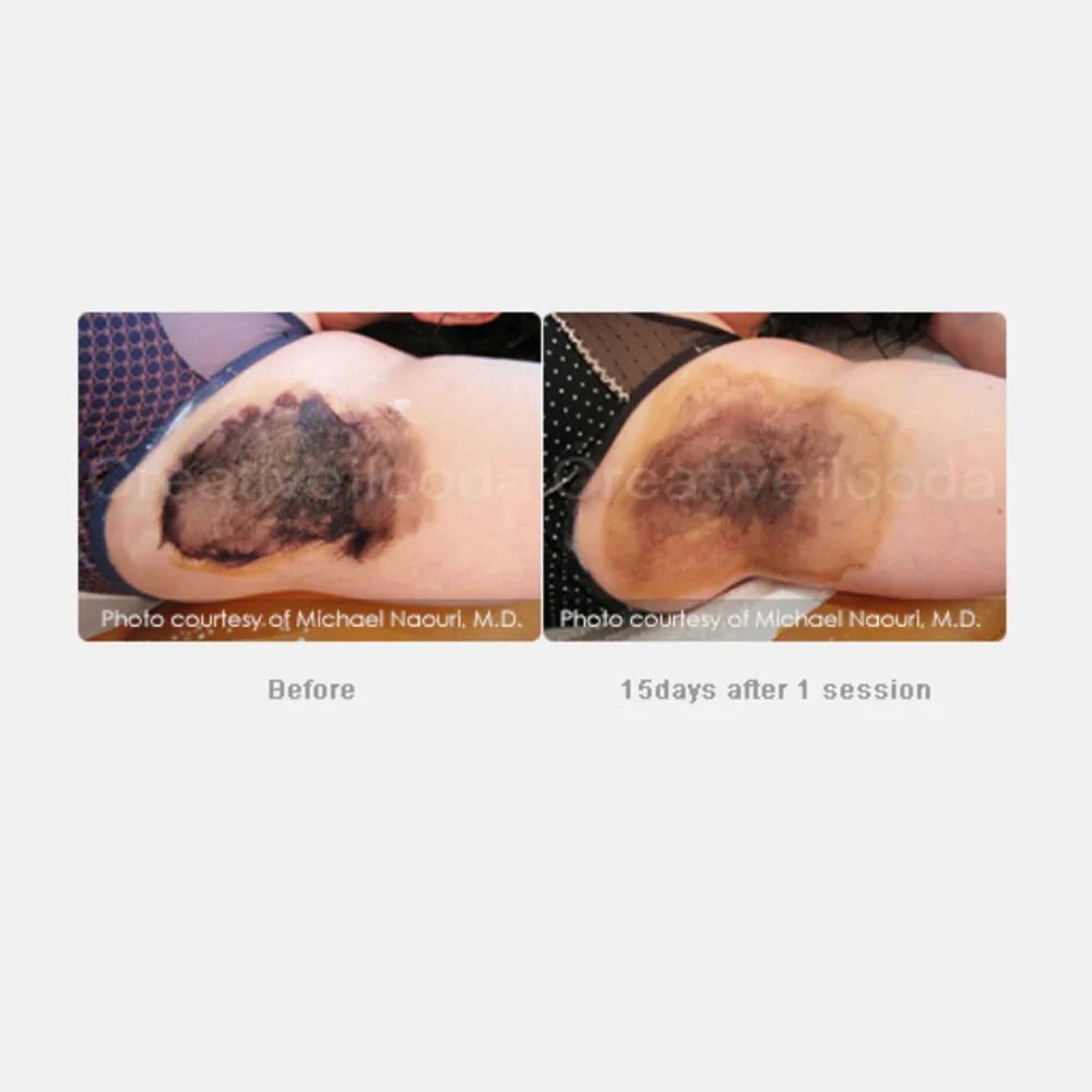 Mariposa Aesthetics & Laser Center Secret RF Microneedling Device