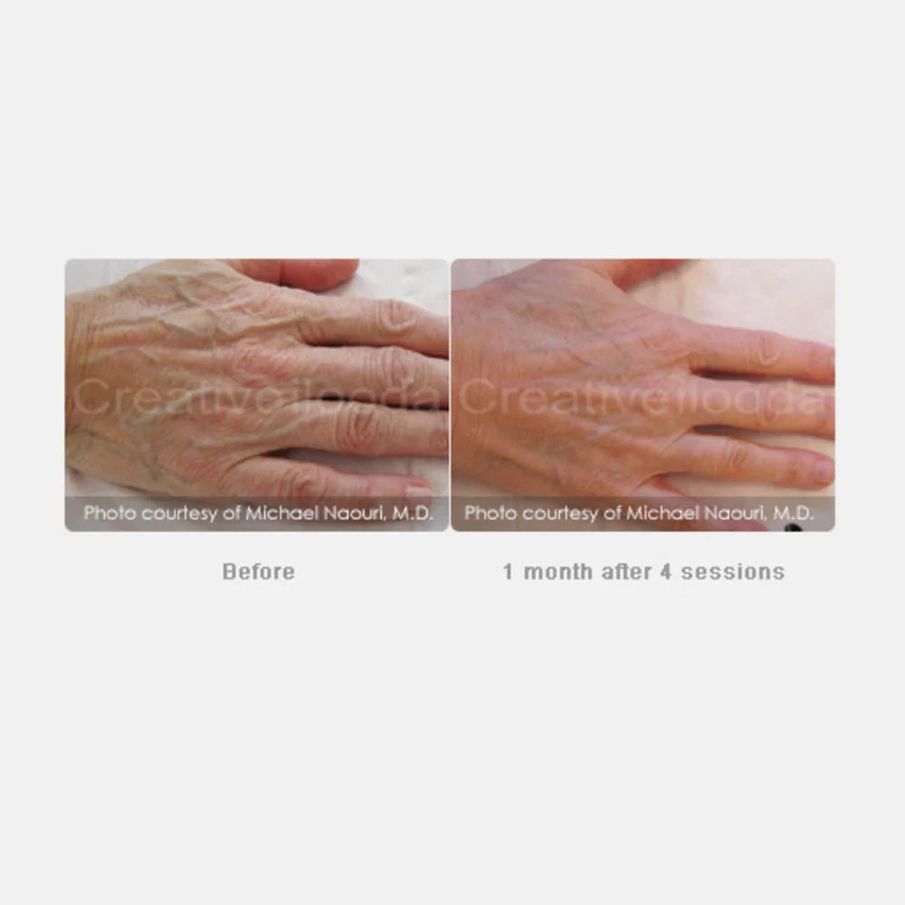 Mariposa Aesthetics & Laser Center Secret RF Microneedling Device