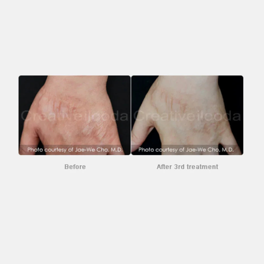 Mariposa Aesthetics & Laser Center Secret RF Microneedling Device