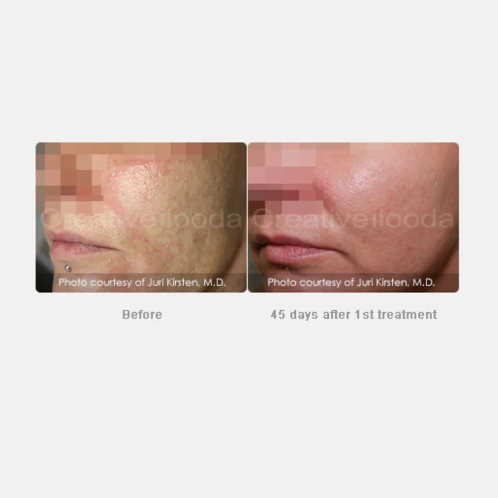 Mariposa Aesthetics & Laser Center Secret RF Microneedling Device