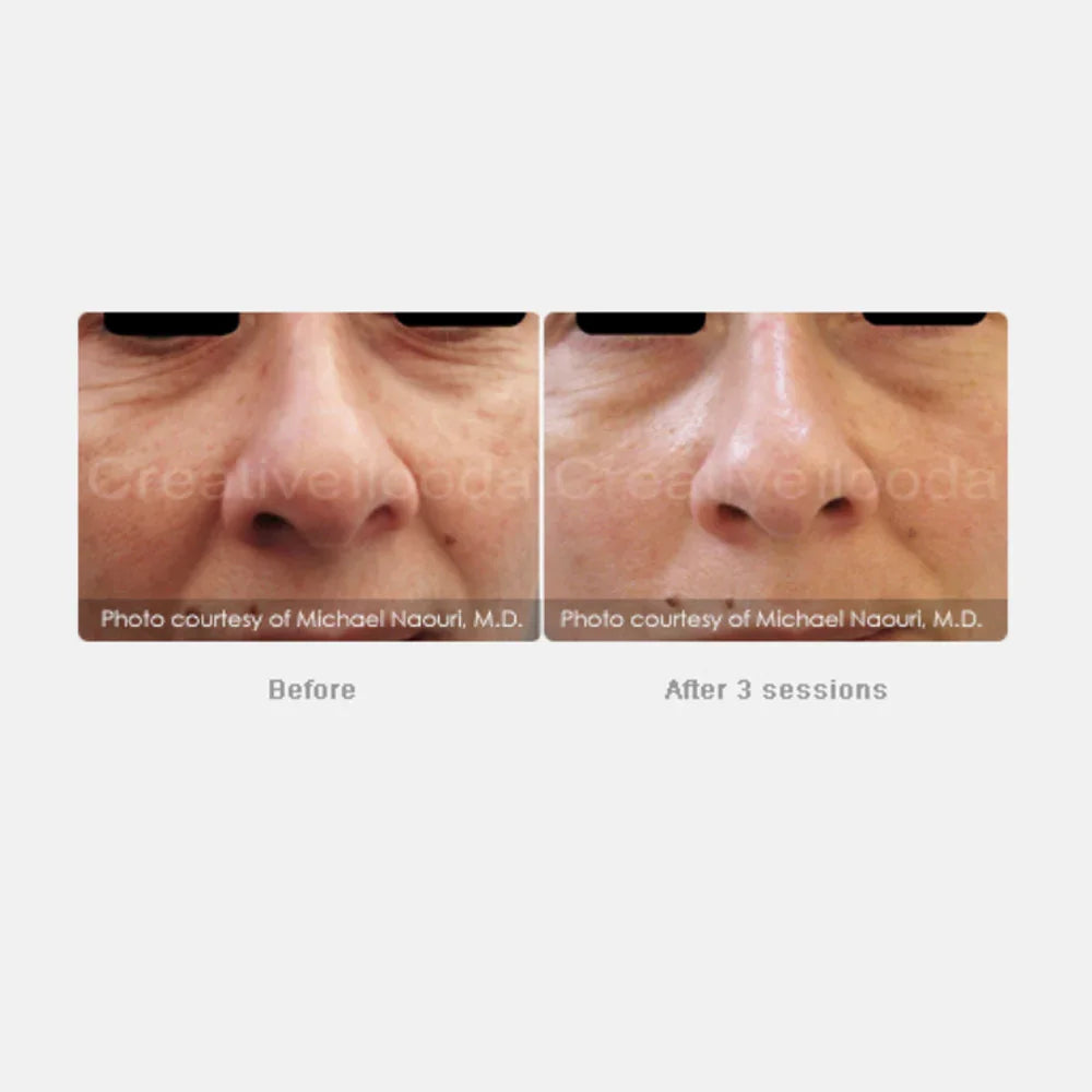 Mariposa Aesthetics & Laser Center Secret RF Microneedling Device