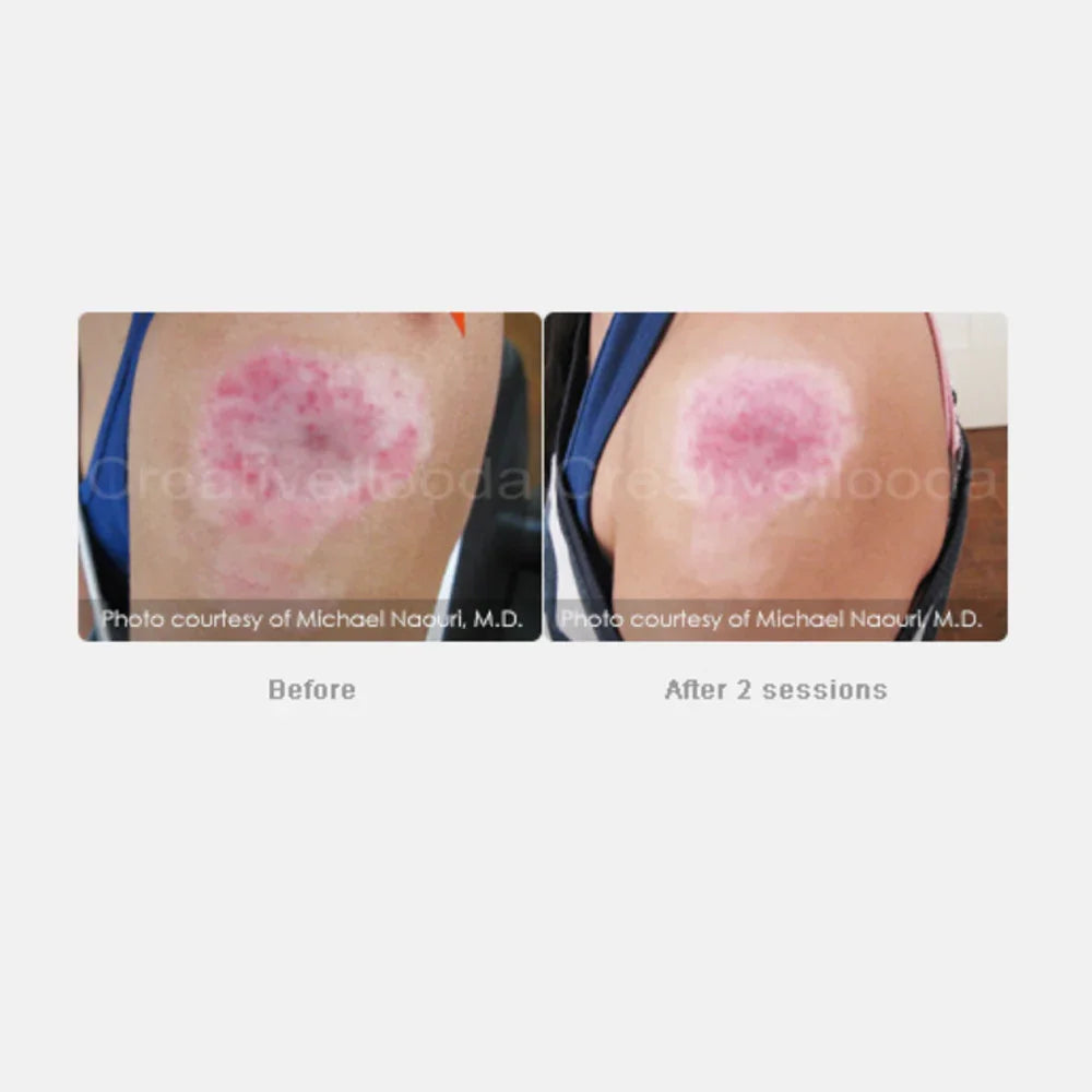 Mariposa Aesthetics & Laser Center Secret RF Microneedling Device