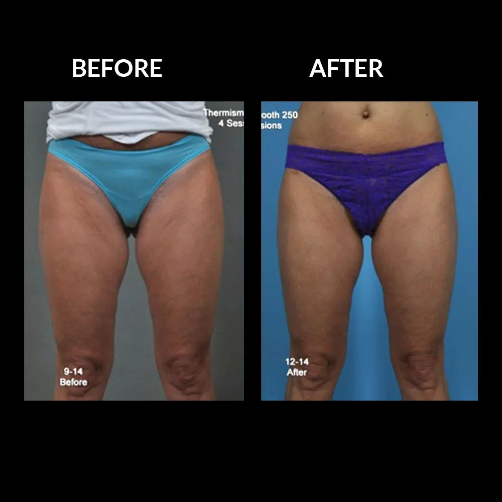 Mariposa Aesthetics & Laser Center THERMIsmooth® BODY Skin Tightening Treatments
